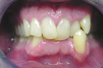 Invisalign before 372718