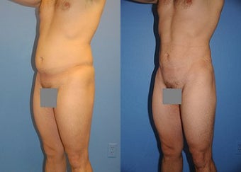 Liposuction before 636186