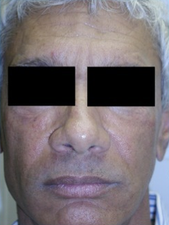 Silicone Microdroplet Therapy for Facial Atrophy after 334062