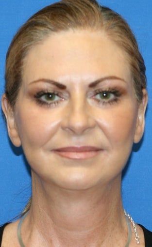 Facelift, Fat Transfer, Upper Bleph, Lower Eyelid Skin Pinch after 424181