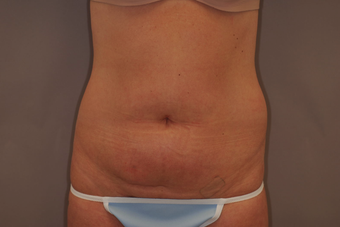 Tummy Liposuction before 229694