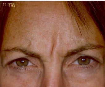 Botox before 469280