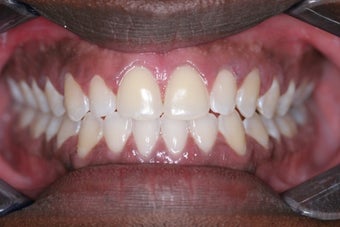 Invisalign after 372713