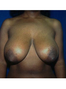 Bilateral Breast Reduction before 250001