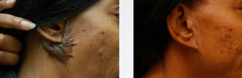 Keloid Repair before 346219