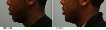 African American Lip Reduction before 445515