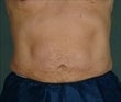 Lipo to Tummy after 478031