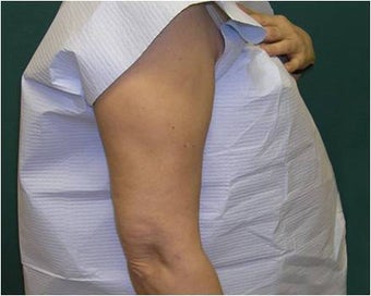 Liposuction of the arms after 589893