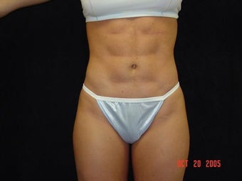 Liposuction Abdomen, Waist, Flanks, Outer Thighs with 6 Pack Abdominal Etching after 203550