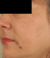 Melasma Treatment after 120084