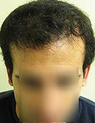 FUE – BHT by SFET Using Nape, Beard and Chest Hair Only after 196037