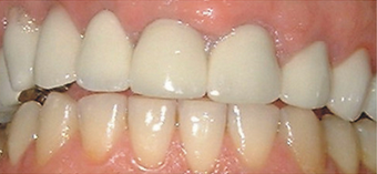 crown lengthening on temporary crowns after 607255