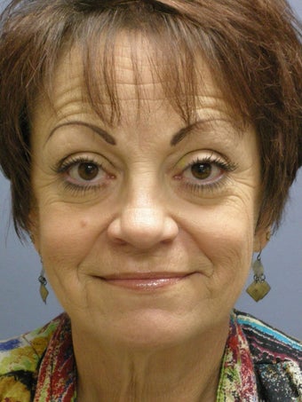 Lite Lift, Brow Lift 523289
