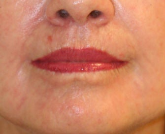 Lip lift, corner of lip lift, and laser treatment of wrinkles around lips after 299916