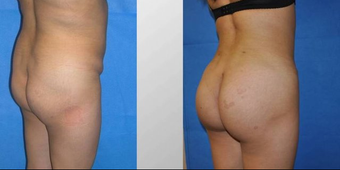 Fat transfer buttock augmentation before 163651