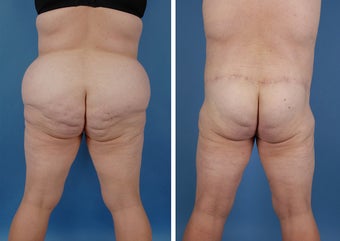 Bilateral Lower Body Lift and Liposuction 303678