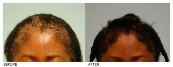 Female Hair Transplant before 134747
