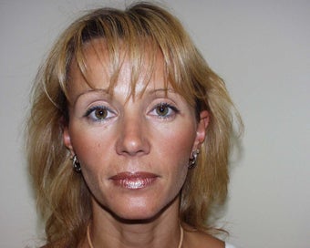 Sculptra before 296029