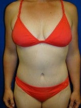Breast Reduction, Tummy Tuck (Abdominoplasty), Mommy Makeover after 404137