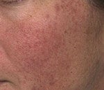 V Beam treatment for Rosacea before 125412