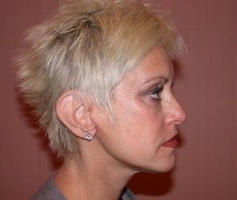 Facelift, Neck Lift, Juvaderm after 191643