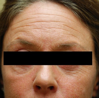 Dysport in the horizontal forehead lines. before 624794