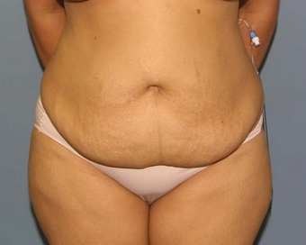 tummy tuck before 527241