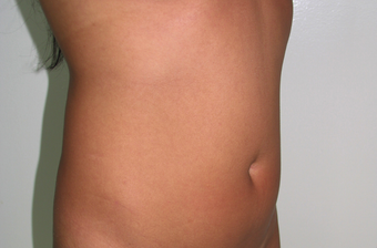 Vaser Liposuction before 229655