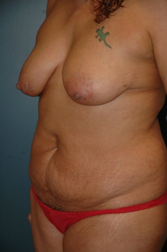 Breast lift and tummy tuck before 238292