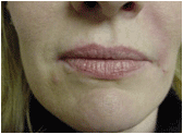restylane after 267544