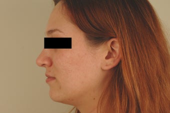 Laser Acne Treatment after 82945