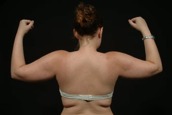 Arm Lift before 289477