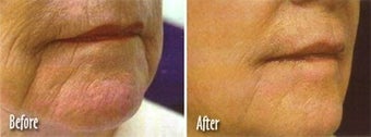 Laser skin resurfacing to get rid of facial lines and wrinkles before 6429