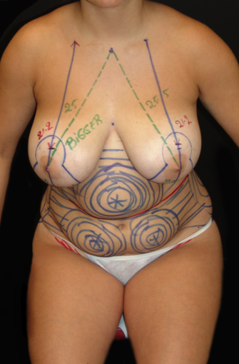 Breast Lift and Tummy Liposuction before 230740