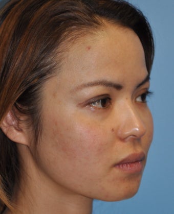 Rhinoplasty-Asian 371839