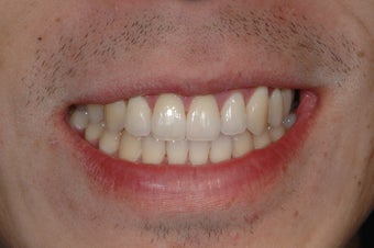 Invisalign Treatment after 356790