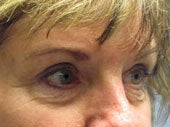 Brow Lift 541474