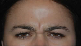 Botox to Treat Frown Lines and Vertical Lines Between Eyebrows before 53758