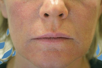 Silicone Microdroplets for Lip Augmentation before 109218