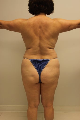 Brazilian butt lift 360617