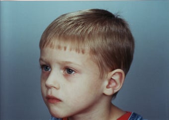 Otoplasty after 322026