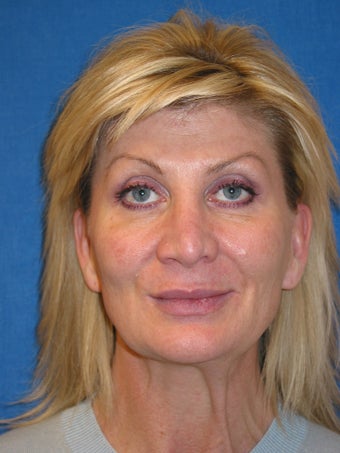 Ultherapy before 613752