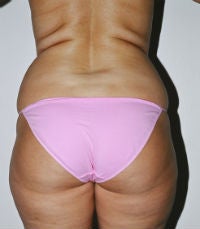 Liposuction of Waist and Flanks, Dr. Steve Laverson, San Diego, CA before 286007