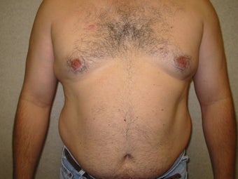 Liposuction before 340028