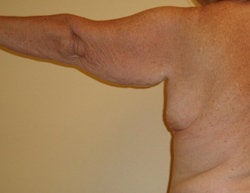 Arm LIft before 330786
