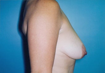 Vertical Mastopexy (Breast Lift) w/ Saline Implants before 247613