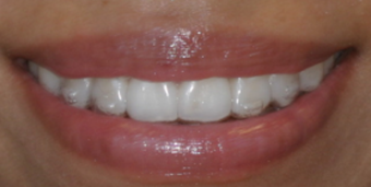 Invisalign before and afters after 151761