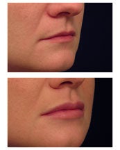 Restylane for Lip Enhancement before 53755