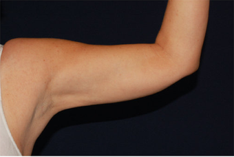 Liposuction after 397170