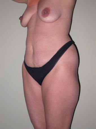 Breast lift, abdominoplasty, liposuction before 273347
